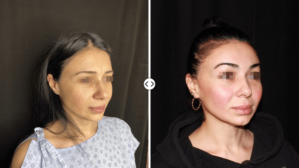 Facelift surgery