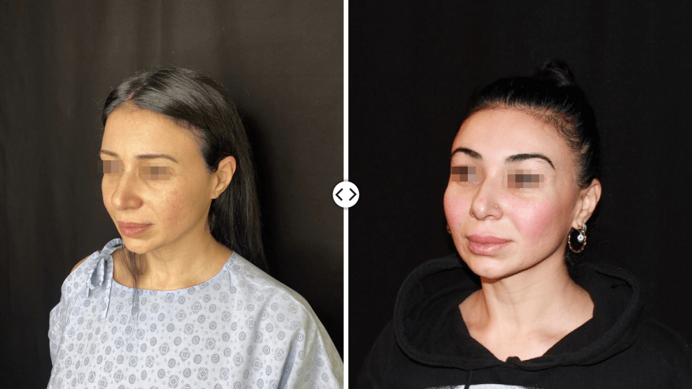 Facelift surgery