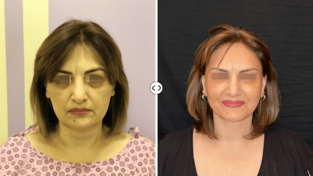 Facelift surgery