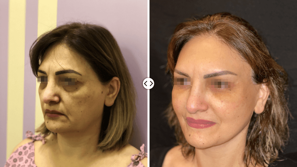 Facelift surgery
