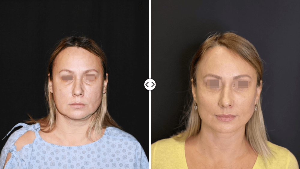 Facelift surgery