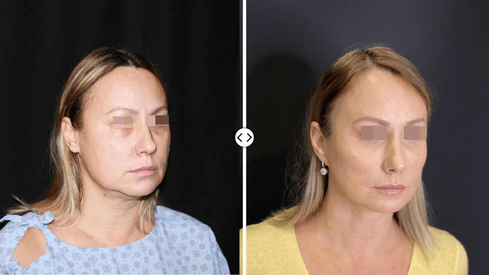 Facelift surgery