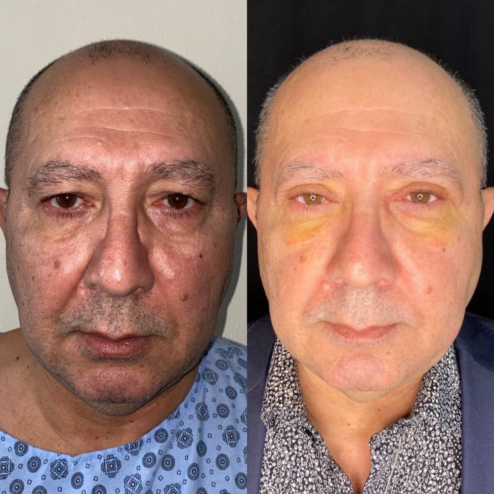 blepharoplasty