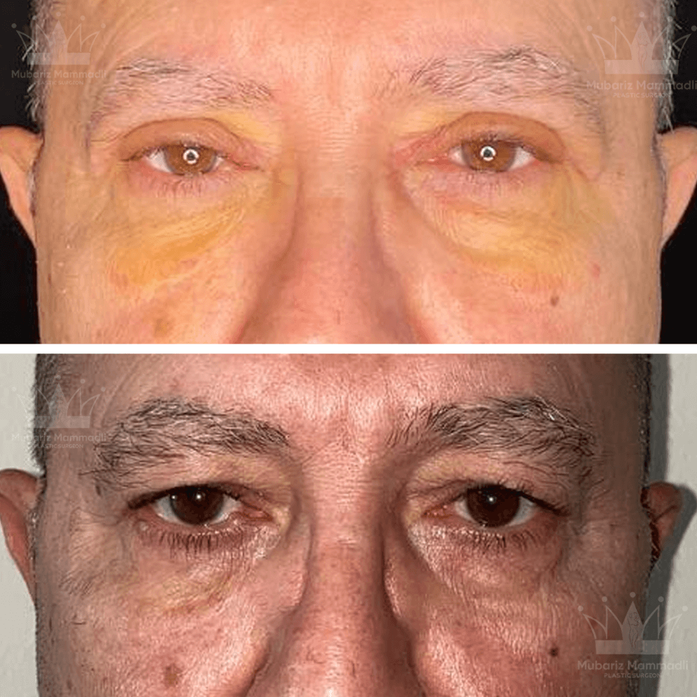 Blepharoplasty (Eyelid surgery)