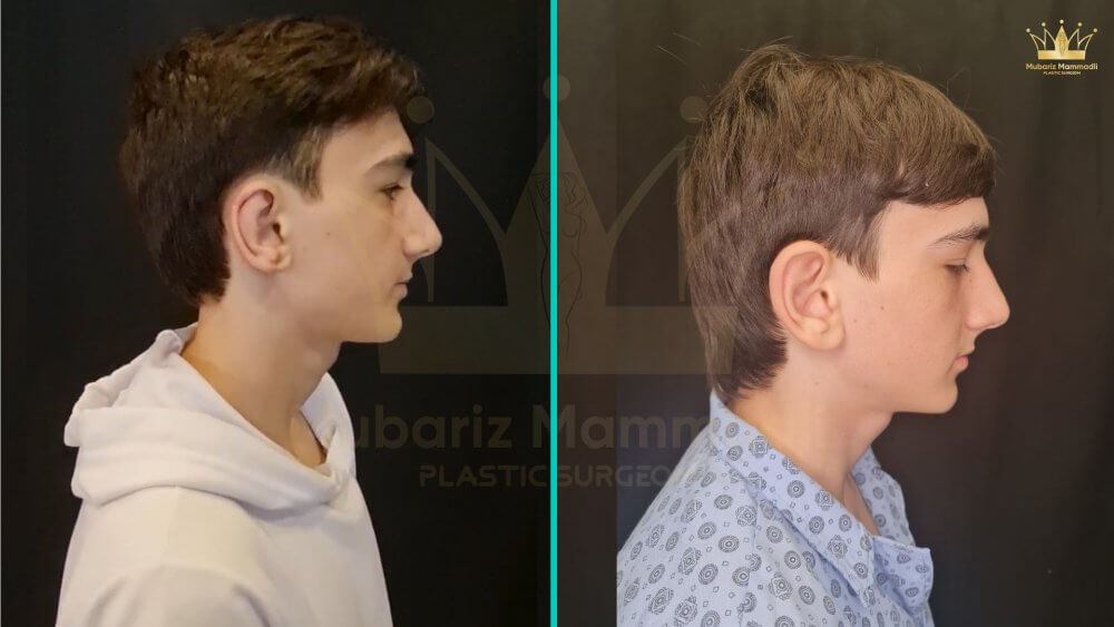 otoplasty-surgery
