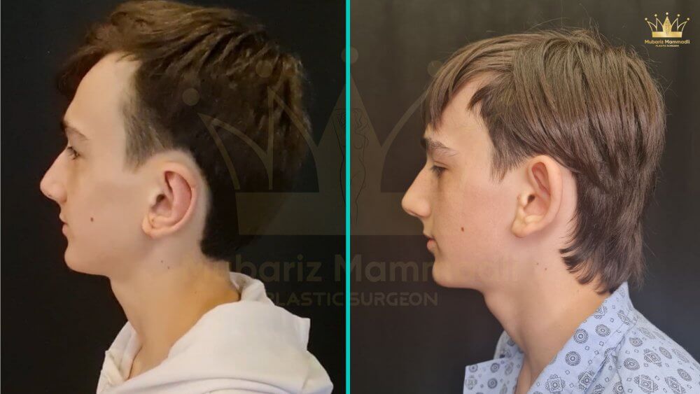 boyun dartma