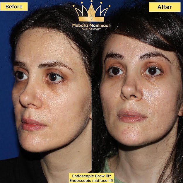 endoscopic midface lift surgery