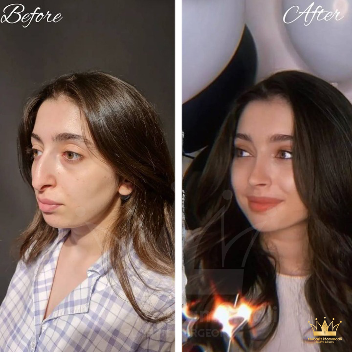 Nose surgery (rhinoplasty, septoplasty)