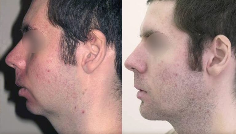 Chin surgery (Mentoplasty)