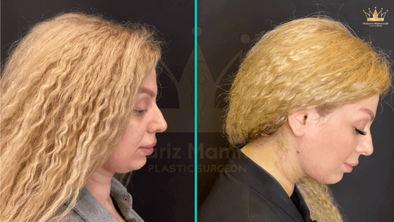Neck lift surgery (platysmoplasty)